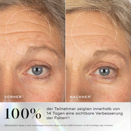 Vorher-Nachher-Bilder der Haut mit sichtbaren Fältchen im Augenbereich, deren Verbesserung nach der Anwendung des Medik8 Exo-PDRN Prismatic+ Serums hervorgehoben wird.