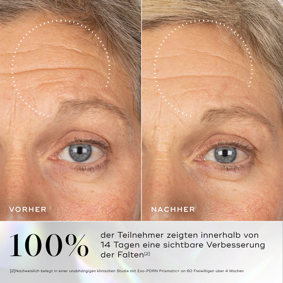 Vorher-Nachher-Bilder der Haut mit sichtbaren Fältchen im Augenbereich, deren Verbesserung nach der Anwendung des Medik8 Exo-PDRN Prismatic+ Serums hervorgehoben wird.-hover-1